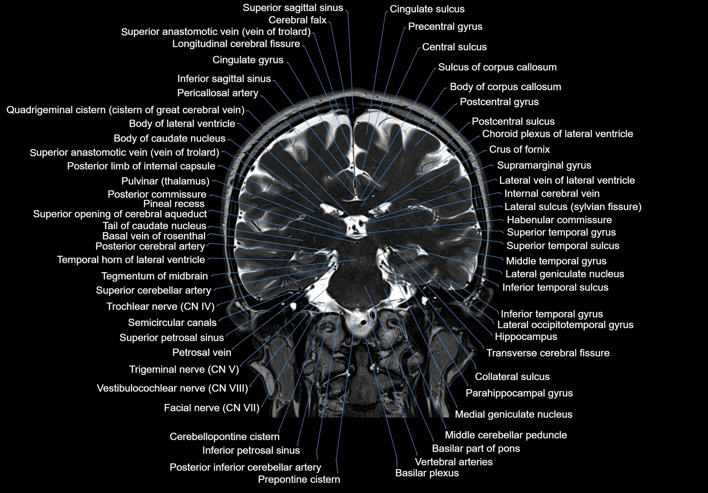 MRI Brain coronal cross sectional labelled anatomy 3T image  -img-00001-00044.webp